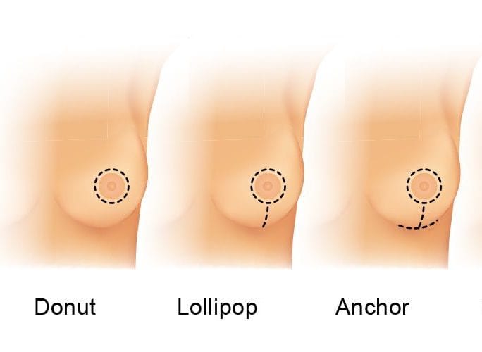 breast reduction, breast lift, plastic surgery, scar pattern, anchor incision