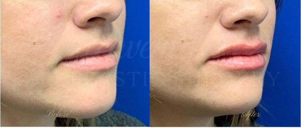Lip filler, lip injection, juvederm, volbella, bigger lips, more lip volume Lip filler, lip injection, juvederm, volbella, bigger lips, more lip volume