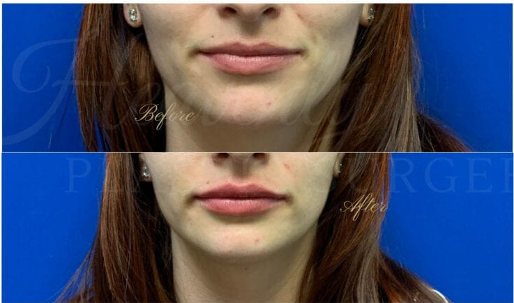 Lip filler, lip injection, juvederm, volbella, bigger lips, more lip volume