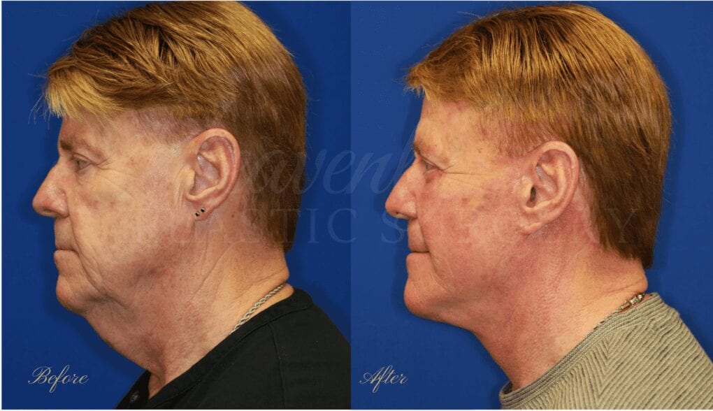 facelift, face lift, neck lift, plastic surgery