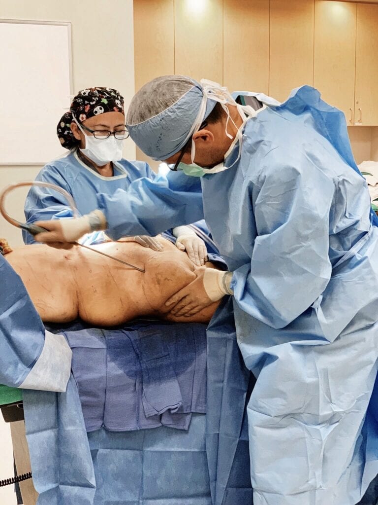 thigh lift surgery, liposuction