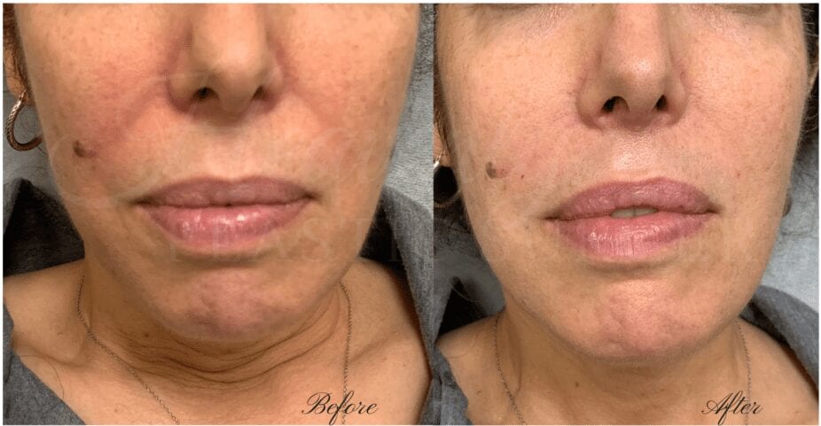 Copy-of-Heavenly-5-e1556830749623 filler, juvederm, vollure, nasolabial fold filler, cheek lines