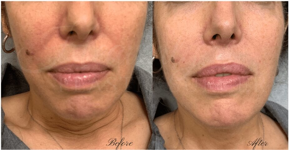 filler, juvederm, vollure, nasolabial fold filler, cheek lines