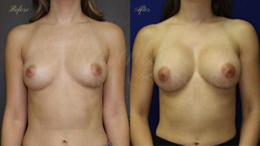 Before and after of a 20 year old female who had a breast augmentation with silicone implants