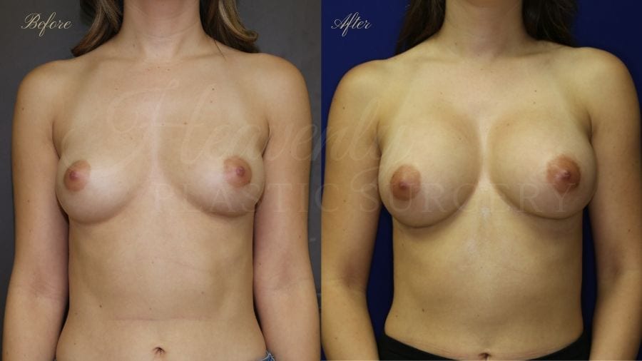 Before and after of a 20 year old female who had a breast augmentation with silicone implants Before and after of a 20 year old female who had a breast augmentation with silicone implants