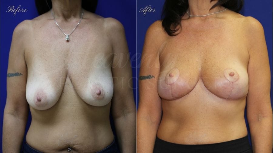 Plastic surgery, plastic surgeon, before and after breast lift, breast lift, mastopexy