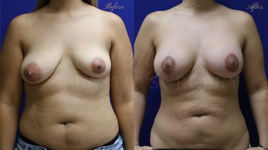 Plastic surgery, plastic surgeon, breast augmentation, breast implants, augmentation mammaplasty, before and after breast augmentation, bigger breasts, bigger boobs, breast lift, mastopexy, liposuction