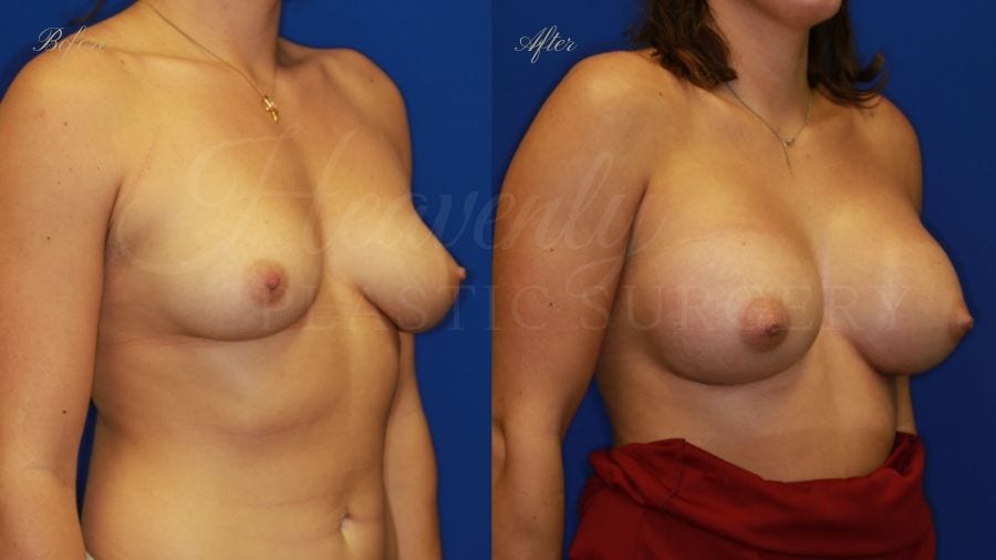 Plastic surgery, plastic surgeon, breast augmentation, breast implants, augmentation mammaplasty, before and after breast augmentation, bigger breasts, bigger boobs