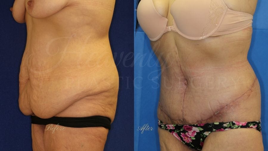 Tummy Tuck, Abdominoplasty, Liposuction, before and after bodylift, plastic surgery, plastic surgeon, bodylift