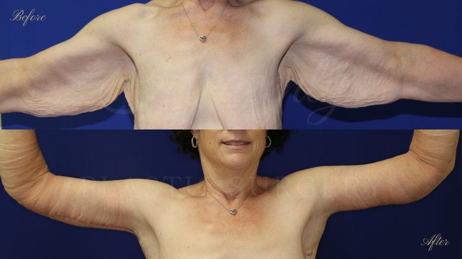 arm lift, extra arm skin, flabby arms, brachioplasty, before and after arm lift, plastic surgery, plastic surgeon, arm lift specialist, arm lift expert