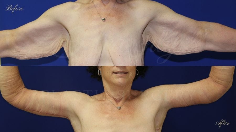 arm lift, extra arm skin, flabby arms, brachioplasty, before and after arm lift, plastic surgery, plastic surgeon, arm lift specialist, arm lift expert arm lift, extra arm skin, flabby arms, brachioplasty, before and after arm lift, plastic surgery, plastic surgeon, arm lift specialist, arm lift expert