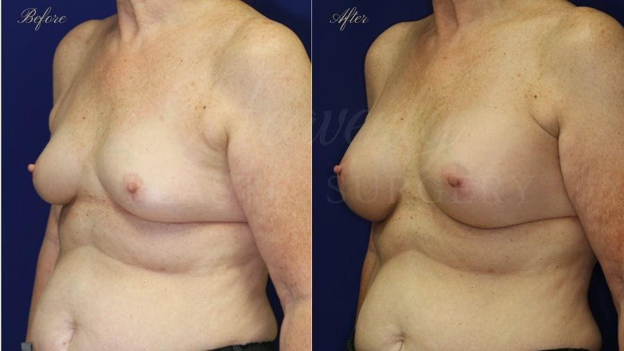 breast augmentation, enhanced breasts, boob job, implants, silicone implants, small implants, natural implants, mini breast augmentation