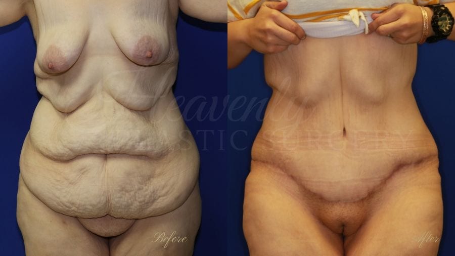 tummy tuck, abdominoplasty, panniculectomy, plastic surgery, plastic surgeon