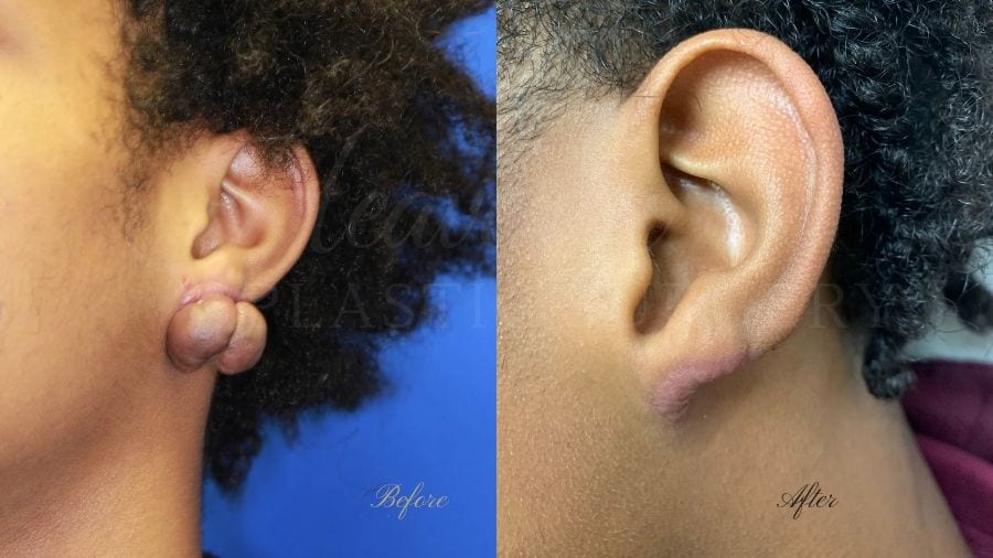 Plastic surgery, plastic surgeon, earlobe repair, before and after, keloid, ear keloid, keloid excision, keloid removal, large keloid