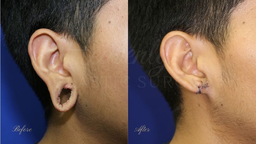 Plastic surgery, plastic surgeon, earlobe repair, before and after Plastic surgery, plastic surgeon, earlobe repair, before and after