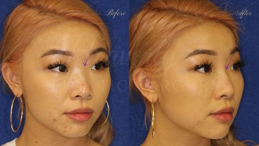 Nonsurgical rhinoplasty, nonsurgical nose job, filler nose, juvederm, vollure, volbella Nonsurgical rhinoplasty, nonsurgical nose job, filler nose, juvederm, vollure, volbella