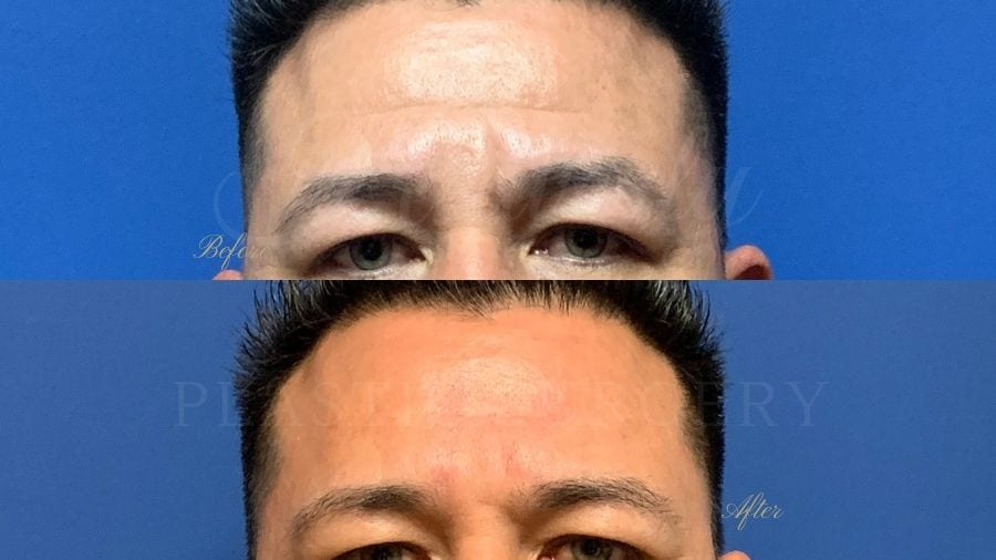 forehead wrinkles, botox, filler, juvederm, volbella, vollure