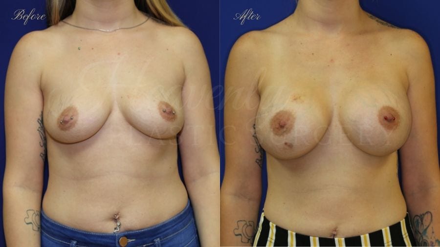 Plastic surgery, plastic surgeon, breast augmentation, breast implants, augmentation mammaplasty, before and after breast augmentation, bigger breasts, bigger boobs, boob job, silicone implants