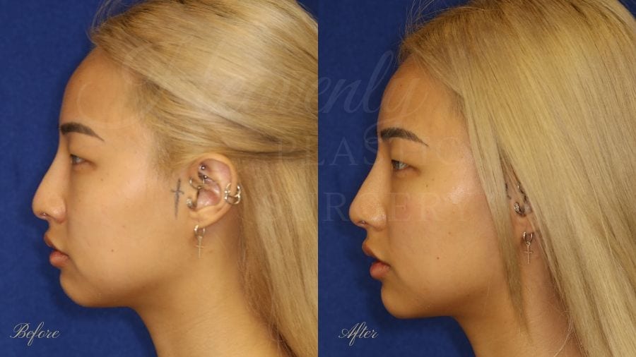 Nonsurgical rhinoplasty, nonsurgical nose job, filler nose, juvederm, vollure, volbella