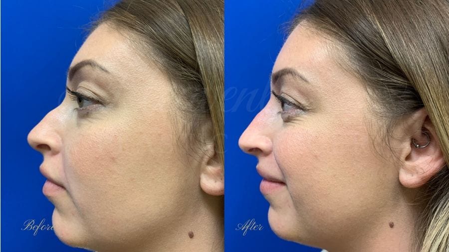 Nonsurgical rhinoplasty, nonsurgical nose job, filler nose, juvederm, vollure, volbella