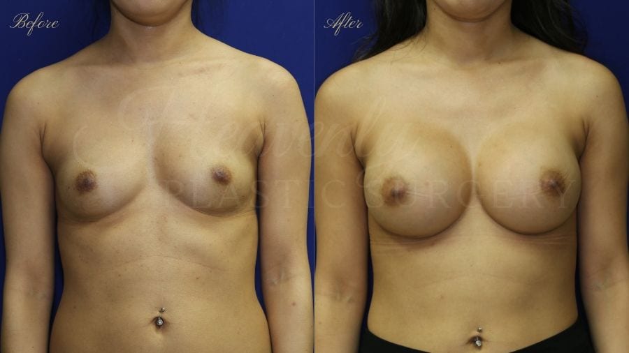 Plastic surgery, plastic surgeon, breast augmentation, breast implants, augmentation mammaplasty, before and after breast augmentation, bigger breasts, bigger boobs, boob job