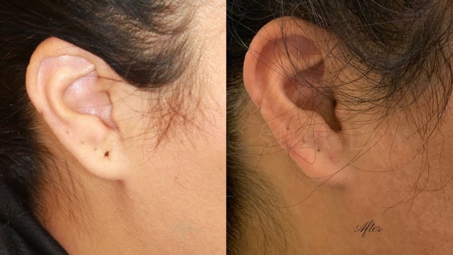 Plastic surgery, plastic surgeon, earlobe repair, before and after Plastic surgery, plastic surgeon, earlobe repair, before and after