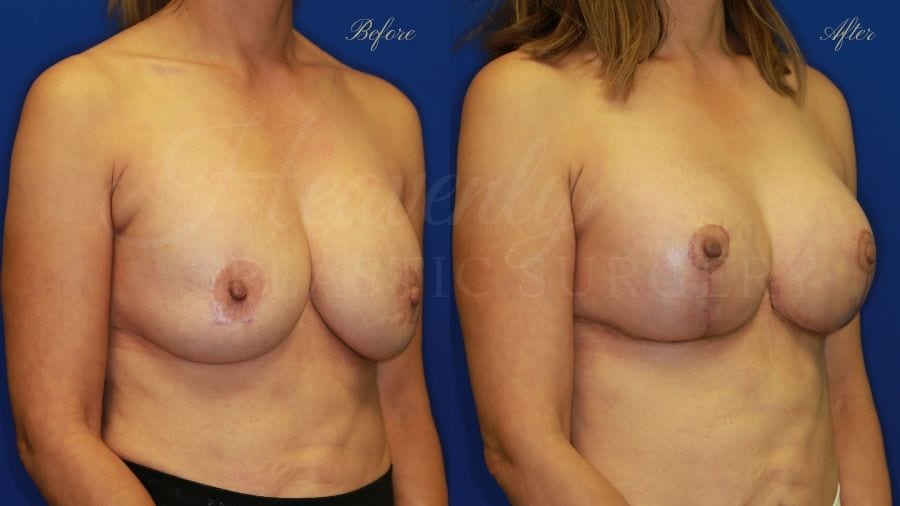 Plastic surgery, plastic surgeon, breast augmentation, breast lift, mastopexy, remove and replace implants, implant exchange, breast implants