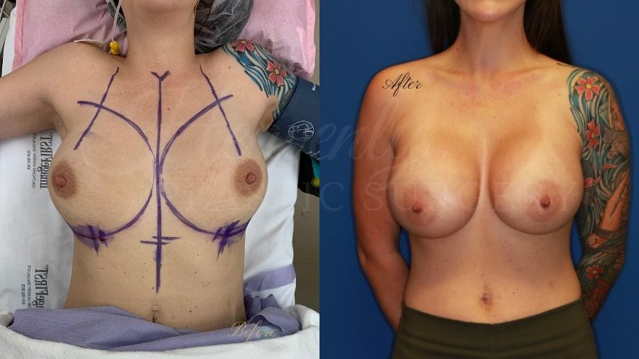 Plastic surgeon, plastic surgery, breast augmentation, breast implants