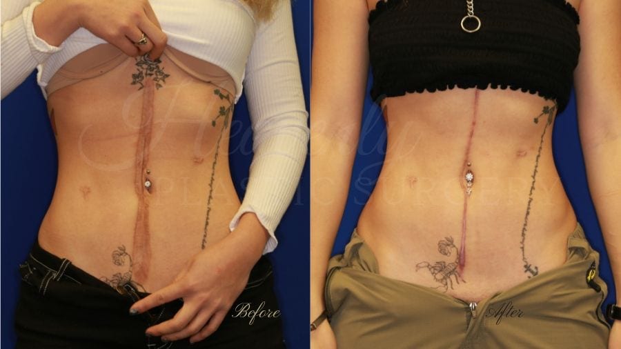 Plastic Surgery, plastic surgeon, scar revision, abdominal scar Plastic Surgery, plastic surgeon, scar revision, abdominal scar