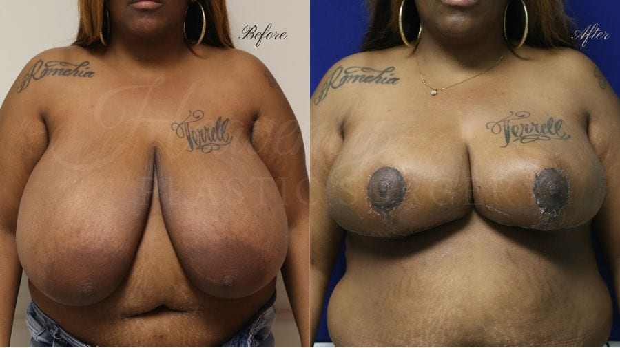 Plastic surgery, plastic surgeon, before and after breast reduction, breast lift, mastopexy, reduction mammaplasty