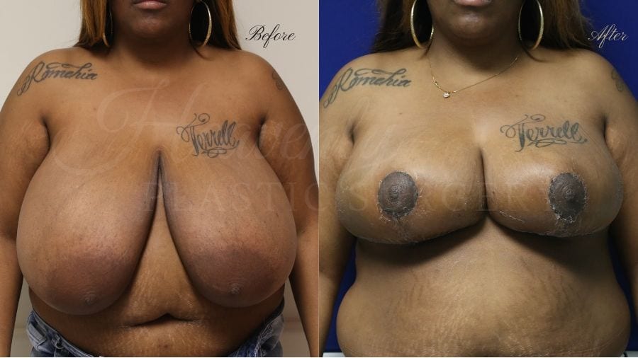 Plastic surgery, plastic surgeon, before and after breast reduction, breast lift, mastopexy, reduction mammaplasty Plastic surgery, plastic surgeon, before and after breast reduction, breast lift, mastopexy, reduction mammaplasty