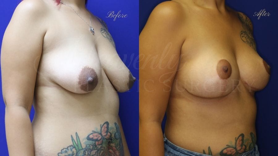 Plastic surgery, plastic surgeon, before and after breast lift, breast lift, mastopexy