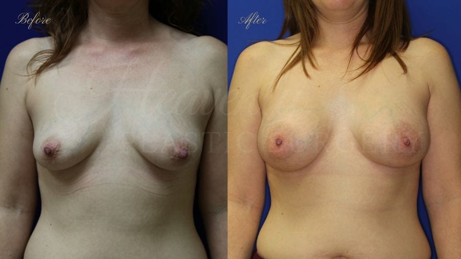 breast augmentation, enhanced breasts, boob job, implants, silicone implants