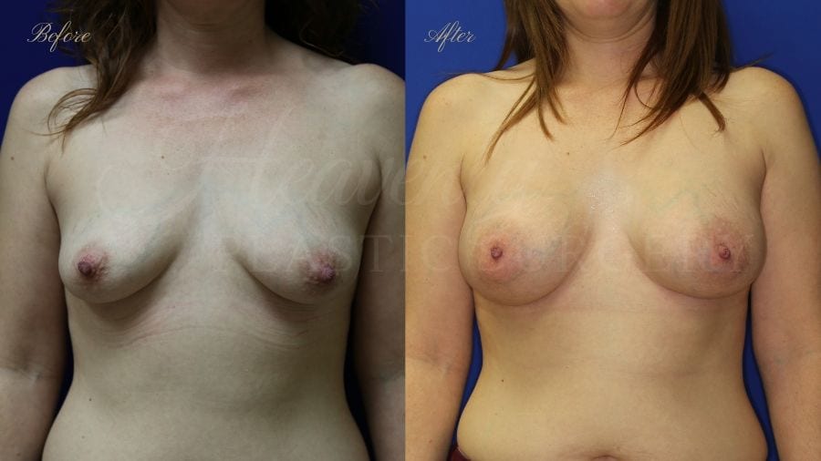 Plastic surgery, plastic surgeon, breast augmentation, breast implants, augmentation mammaplasty, before and after breast augmentation, bigger breasts, bigger boobs, boob job, silicone implants breast augmentation, enhanced breasts, boob job, implants, silicone implants