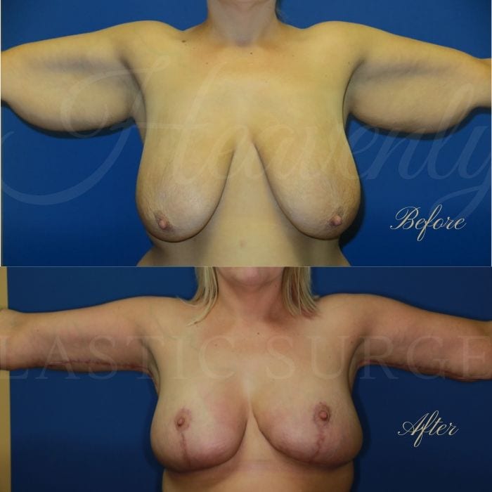 Arm lift, Brachioplasty, breast lift, mastopexy, breast reduction, reduction mammaplasty