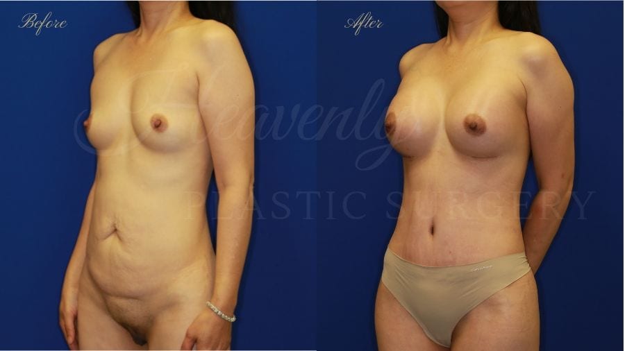 Mommy Makeover, Breast Augmentation, Breast Implants, Tummy Tuck, Abdominoplasty