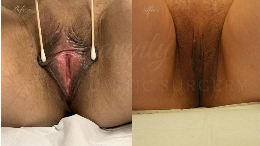 Labiaplasty, vaginal surgery, vaginal rejuvenation, vaginal reconstruction