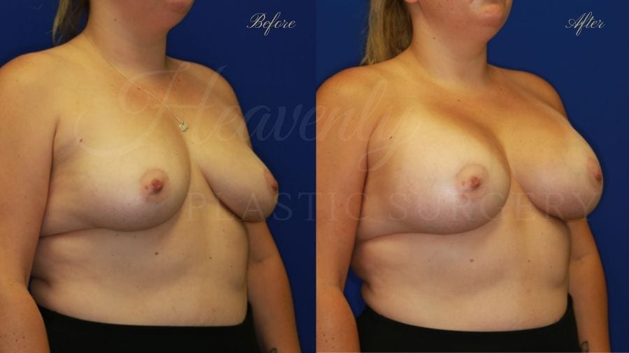 Plastic Surgery, Plastic surgeon, breast augmentation, breast implants, augmentation mammaplasty Plastic Surgery, Plastic surgeon, breast augmentation, breast implants, augmentation mammaplasty