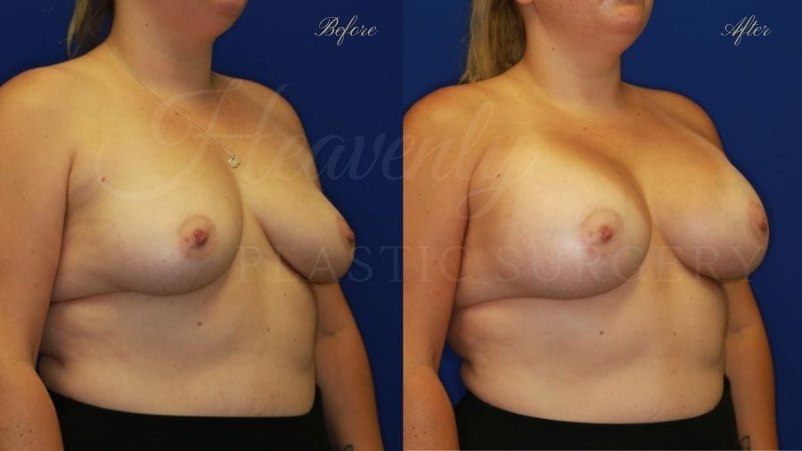 Plastic Surgery, Plastic surgeon, breast augmentation, breast implants, augmentation mammaplasty