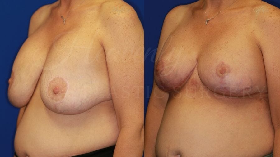 Breast Implant Exchange and Lift - 255cc SRM Silicone under the muscle with Wise-pattern Mastopexy (Anchor Scar)