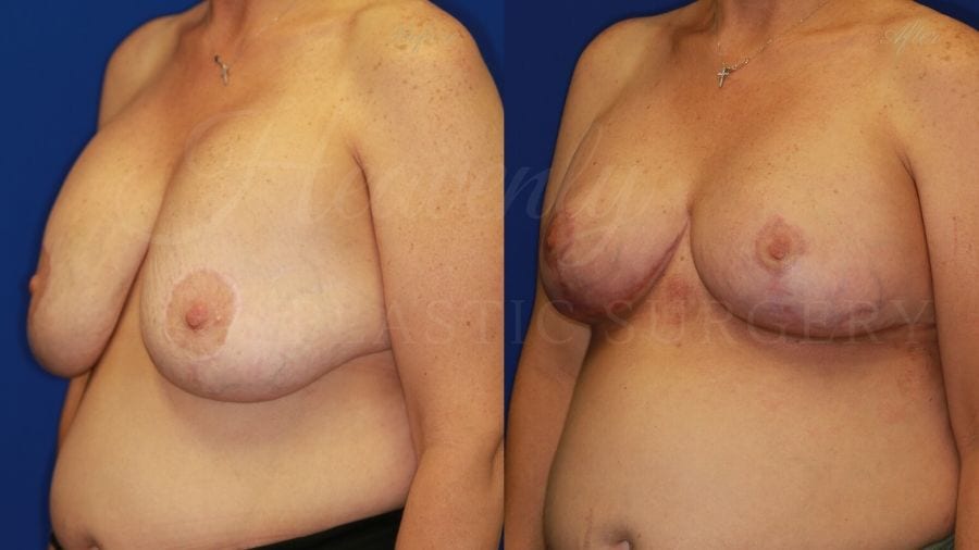 Breast Implant Exchange and Lift - 255cc SRM Silicone under the muscle with Wise-pattern Mastopexy (Anchor Scar) Breast Implant Exchange and Lift - 255cc SRM Silicone under the muscle with Wise-pattern Mastopexy (Anchor Scar)