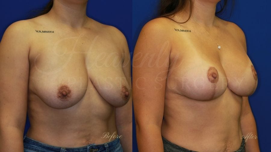 Breast Implants with Lift (Mastopexy-Augmentation - 275cc SRM Silicone under the muscle with Wise-pattern breast lift (anchor scar)