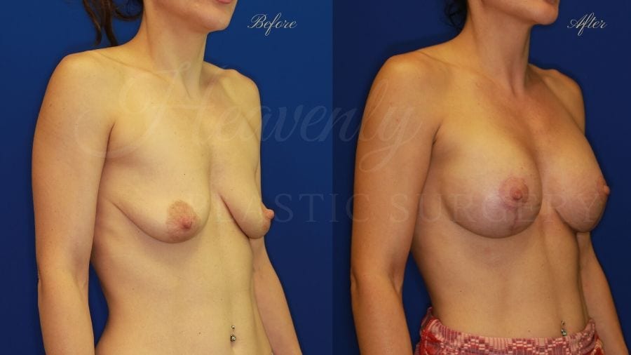 Mastopexy Augmentation (Breast Implants with Lift) - 310cc SRM Silicone breast implants with Wise-pattern breast lift (Anchor scar)
