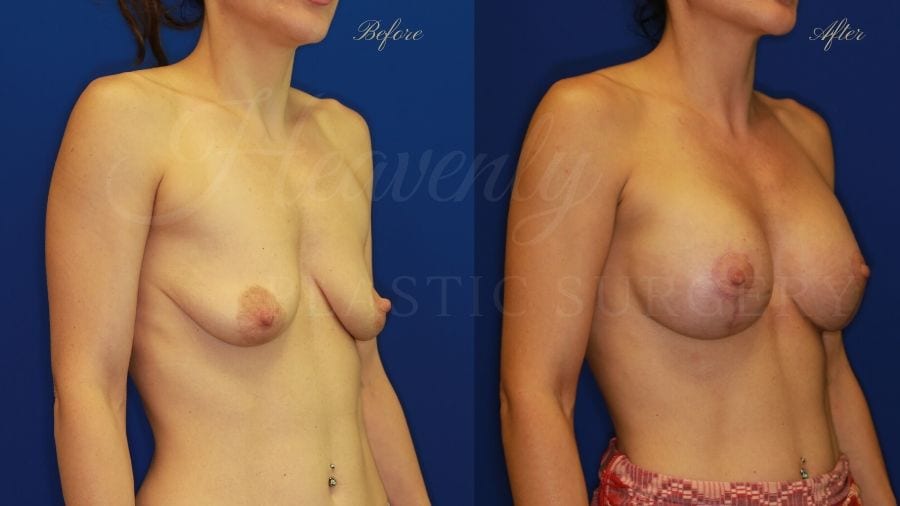 Mastopexy Augmentation (Breast Implants with Lift) - 310cc SRM Silicone breast implants with Wise-pattern breast lift (Anchor scar) Mastopexy Augmentation (Breast Implants with Lift) - 310cc SRM Silicone breast implants with Wise-pattern breast lift (Anchor scar)