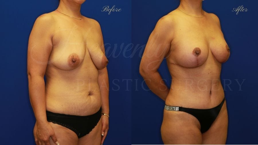 Mommy Makeover - Breast Augmentation, Breast Lift, Tummy Tuck, Liposuction