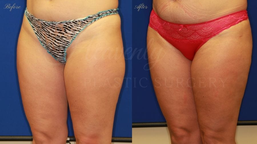 Plastic surgery, plastic surgeon, liposuction thighs Plastic surgery, plastic surgeon, liposuction thighs