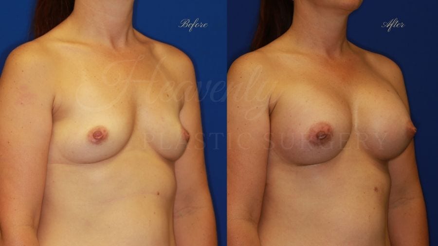 Plastic Surgery, Plastic surgeon, breast augmentation, breast implants, augmentation mammaplasty