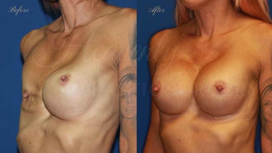 Plastic surgery, plastic surgeon, breast surgery, breast implant revision, deflated breast implant, breast augmentation correction Plastic surgery, plastic surgeon, breast surgery, breast implant revision, deflated breast implant, breast augmentation correction