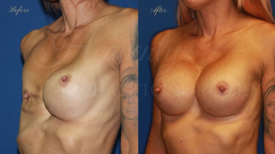 Plastic surgery, plastic surgeon, breast surgery, breast implant revision, deflated breast implant, breast augmentation correction