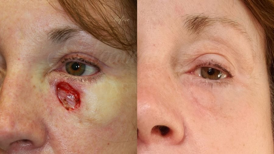 Plastic surgery, plastic surgeon, skin cancer, skin cancer reconstruction, MOHS surgery, basal cell carcinoma, basal cell skin cancer Plastic surgery, plastic surgeon, skin cancer, skin cancer reconstruction, MOHS surgery, basal cell carcinoma, basal cell skin cancer